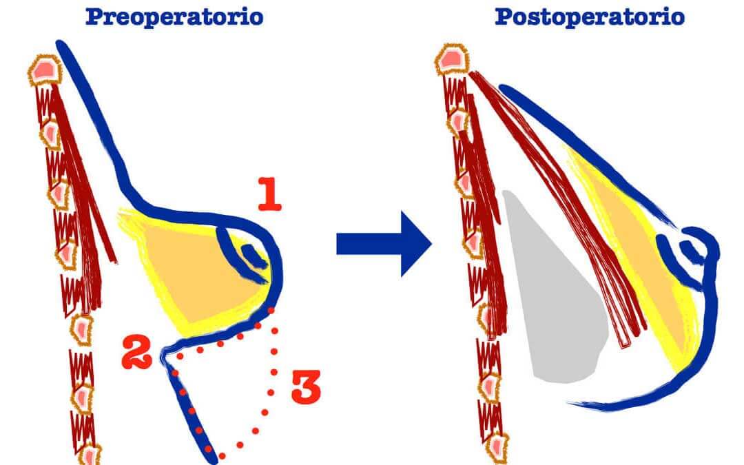 ¿Qué son las mamas tuberosas? ¿Cómo se tratan?