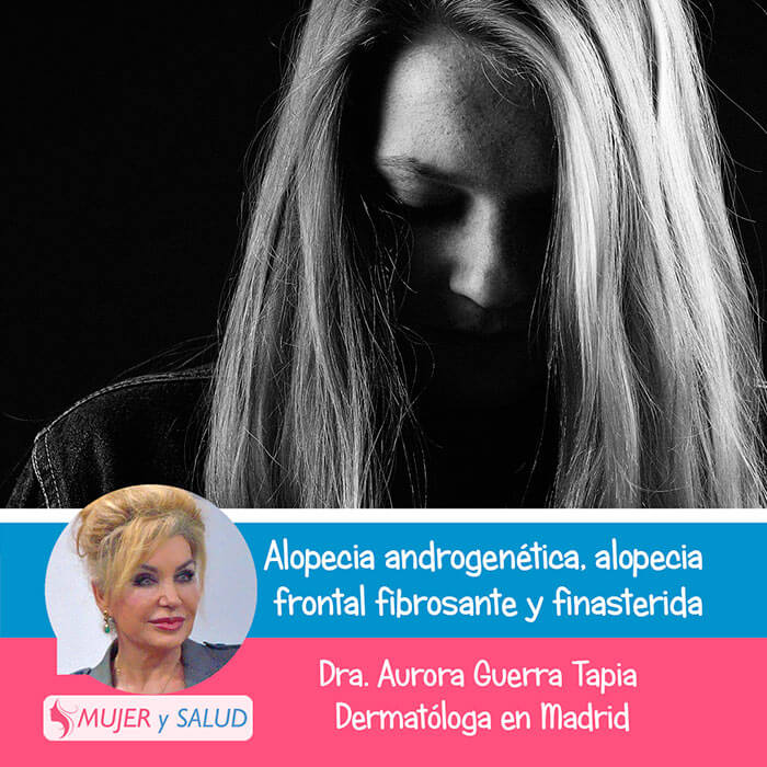 Alopecia androgenetica femenina Alopecia androgenetica femenina