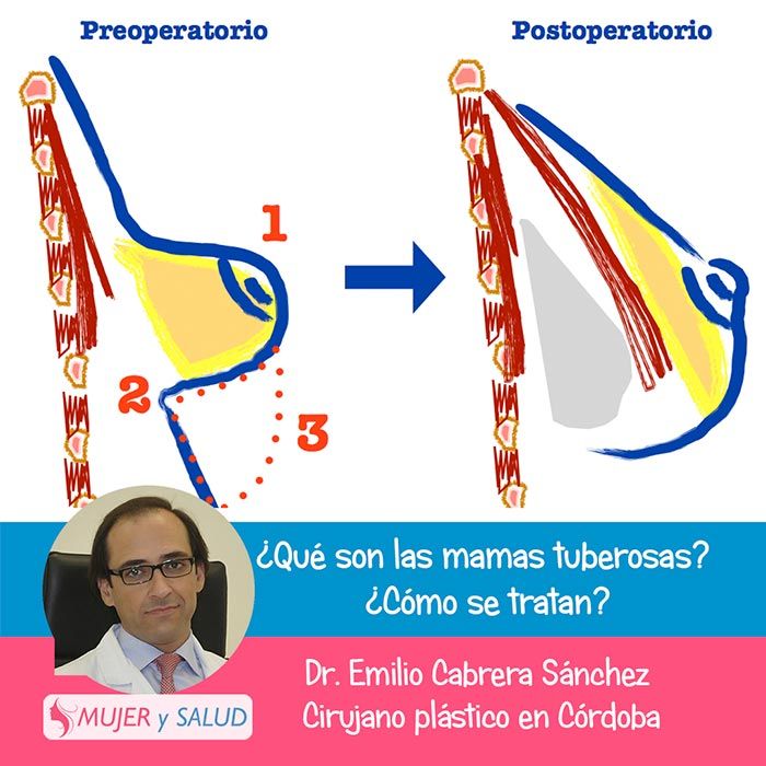 operacion mamas tuberosas operacion mamas tuberosas