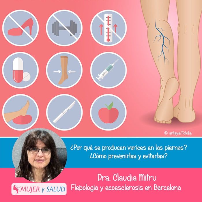 operacion de varices en las piernas operacion de varices en las piernas