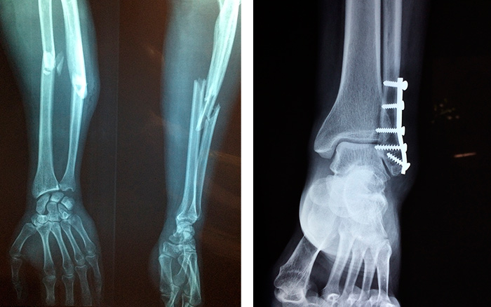 Osteoporosis: causas, síntomas y tratamiento para fortalecer tus huesos