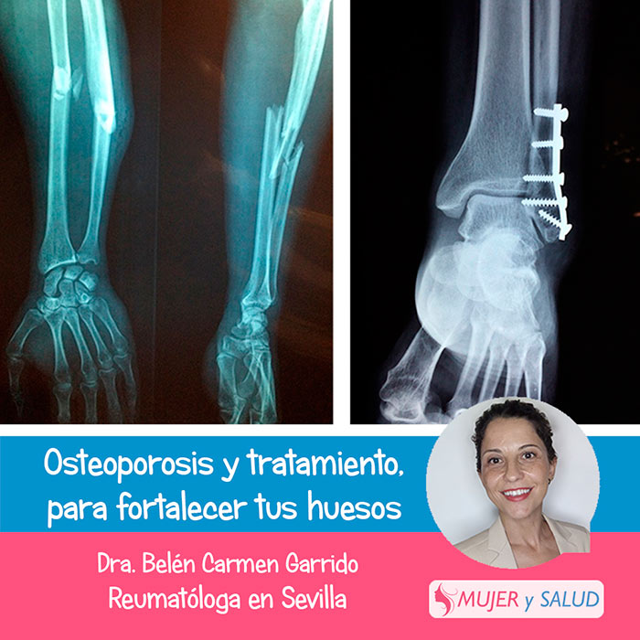 osteoporosis en la columna osteoporosis en la columna