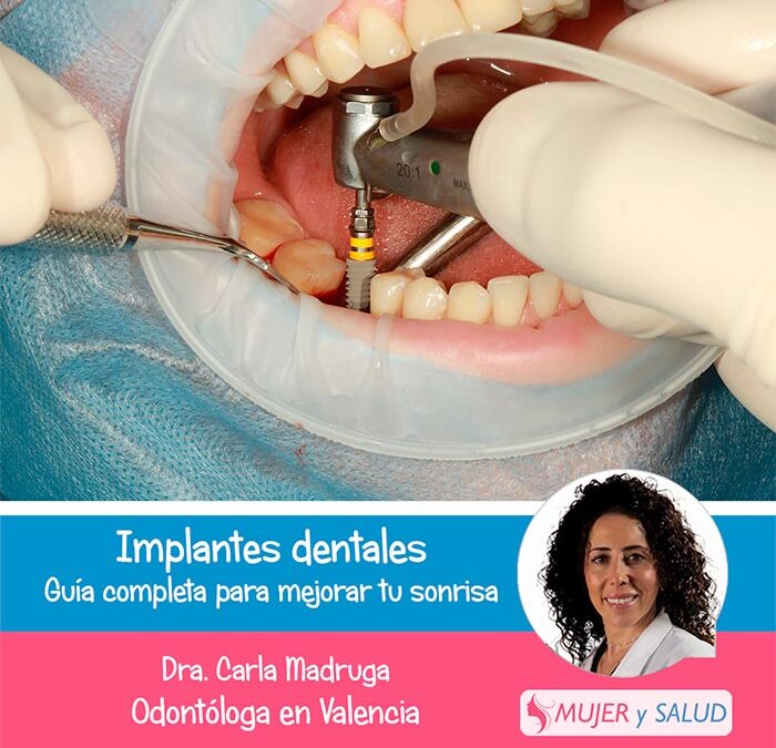 Implantes dentales: guía completa para mejorar tu sonrisa