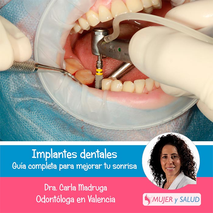 implantes dentales implantes dentales