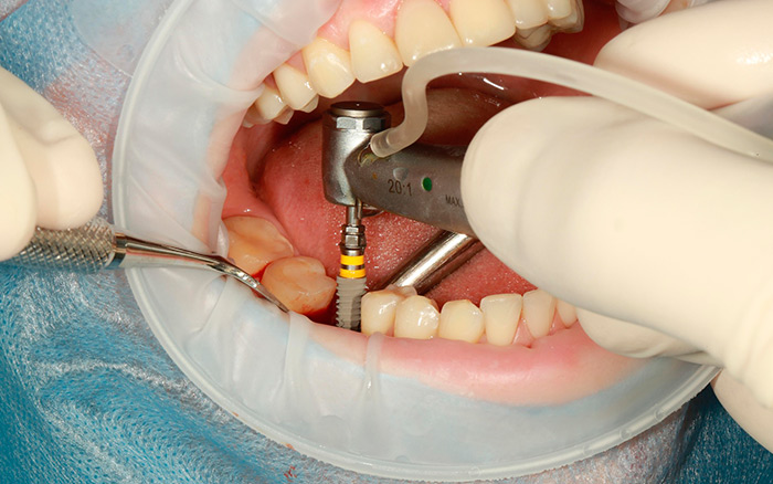 Implantes dentales